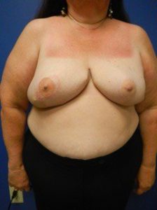 Breast Reconstruction | Plastic Surgery Group of Memphis