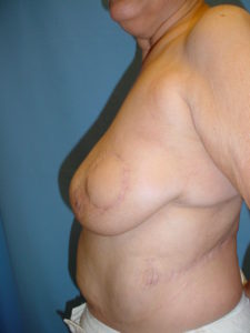 Breast Reconstruction | Plastic Surgery Group of Memphis