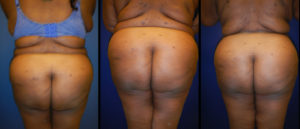 Before and After Brazilian Butt Lift