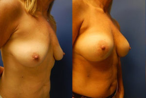 Short Scar Breast Lift and Reduction | Plastic Surgery Group of Memphis