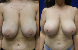 Short Scar Breast Lift and Reduction