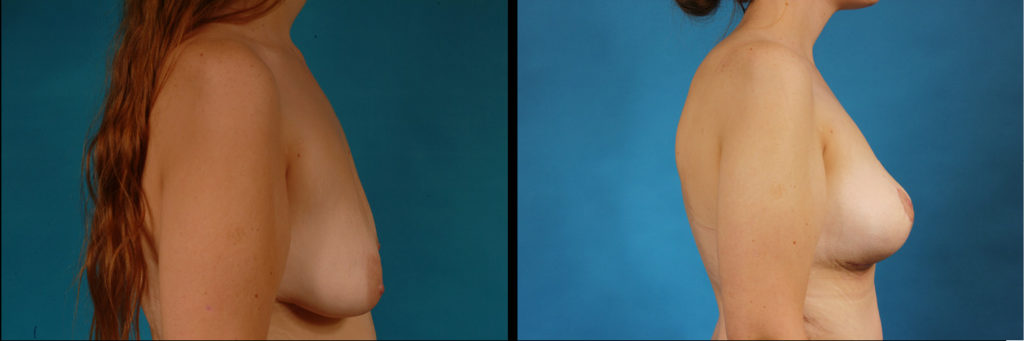 Augmentation Mastopexy Before and After