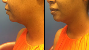 Chin and Neck Contouring Before