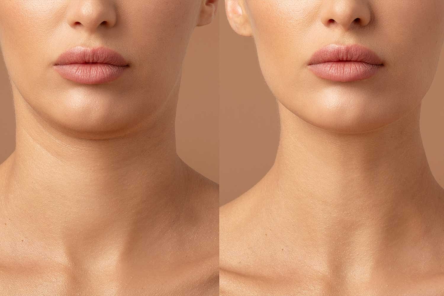 Eliminate Fat with Neck Contouring