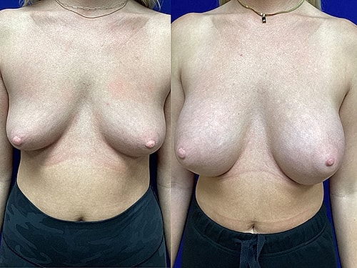 Breast Implant Procedure | Plastic Surgery Group of Memphis