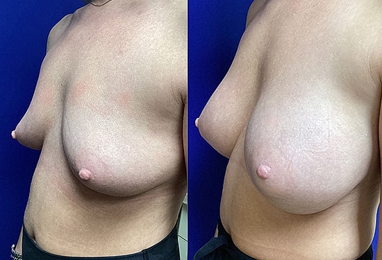 Breast Implant Procedure | Plastic Surgery Group of Memphis
