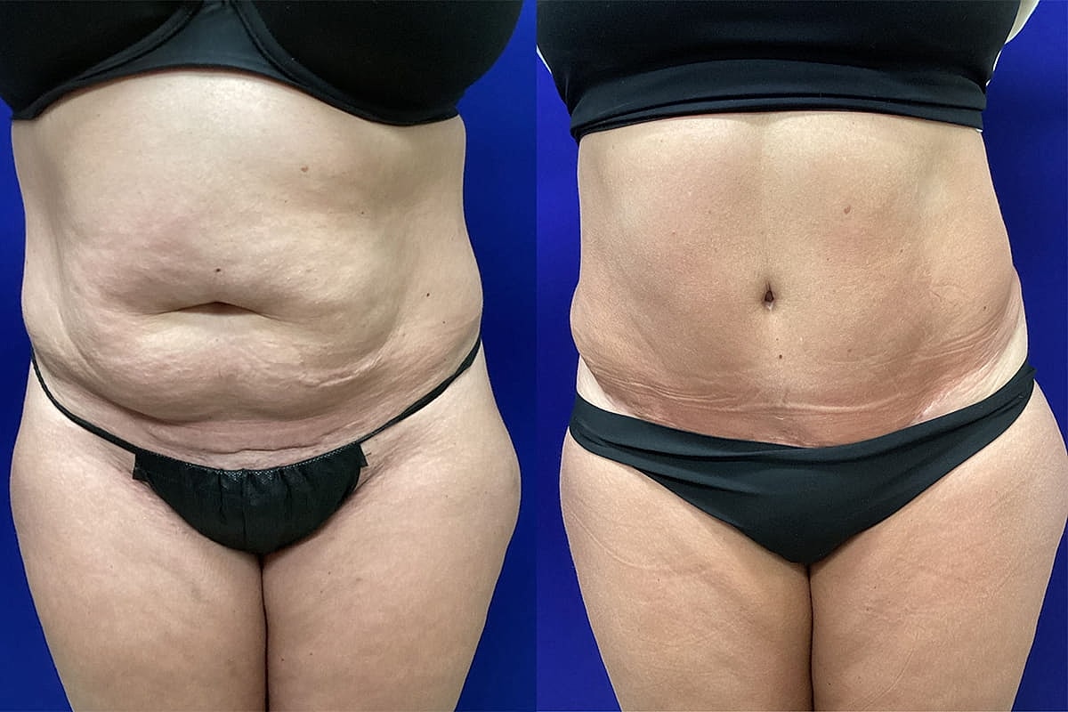 Before and After Abdominoplasty
