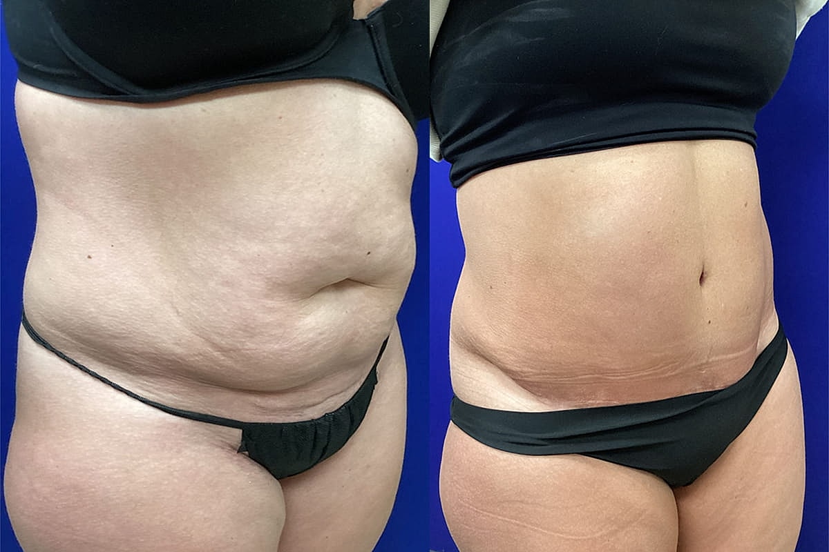 Before and After Abdominoplasty
