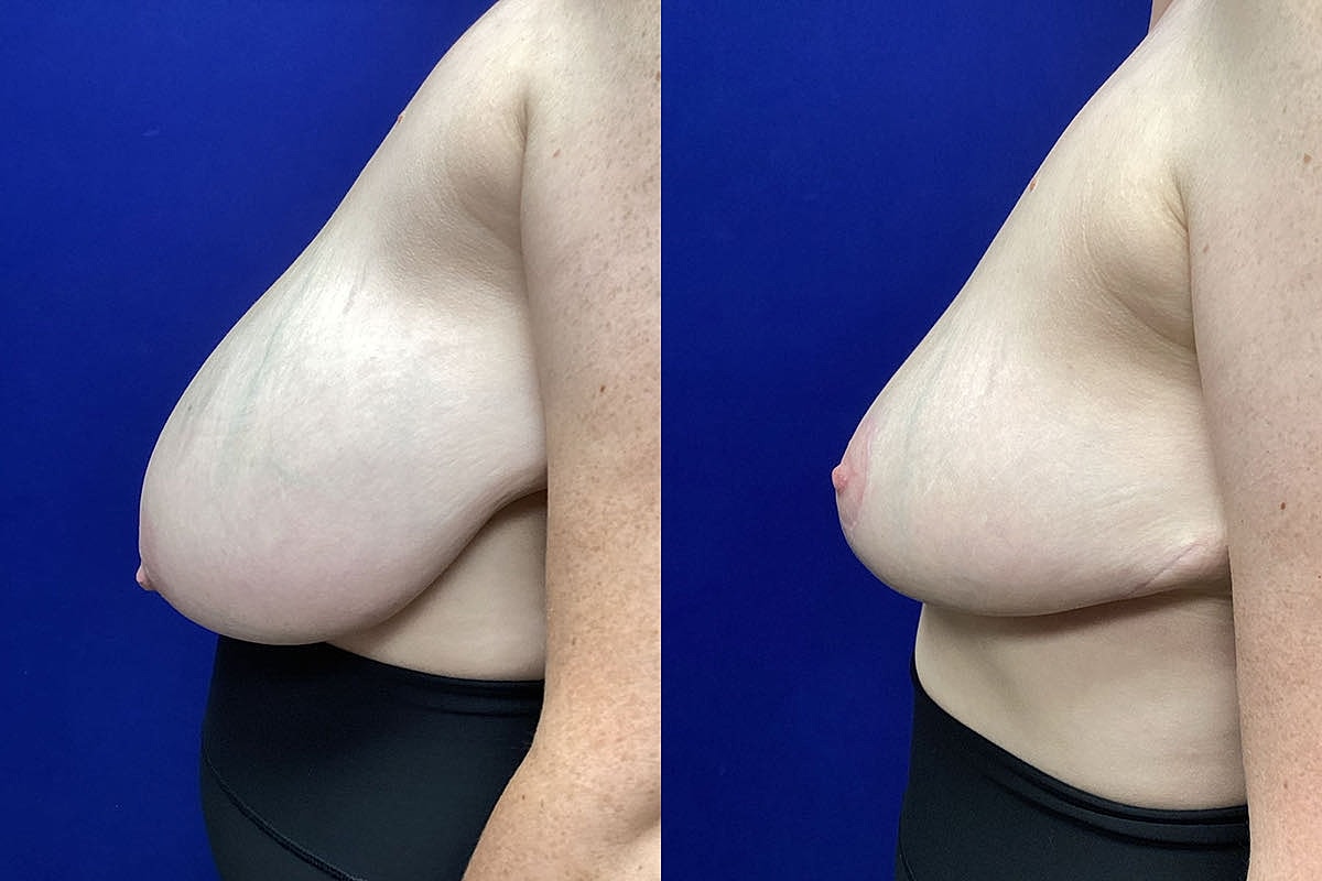 Short Scar Breast Lift and Reduction | Plastic Surgery Group of Memphis