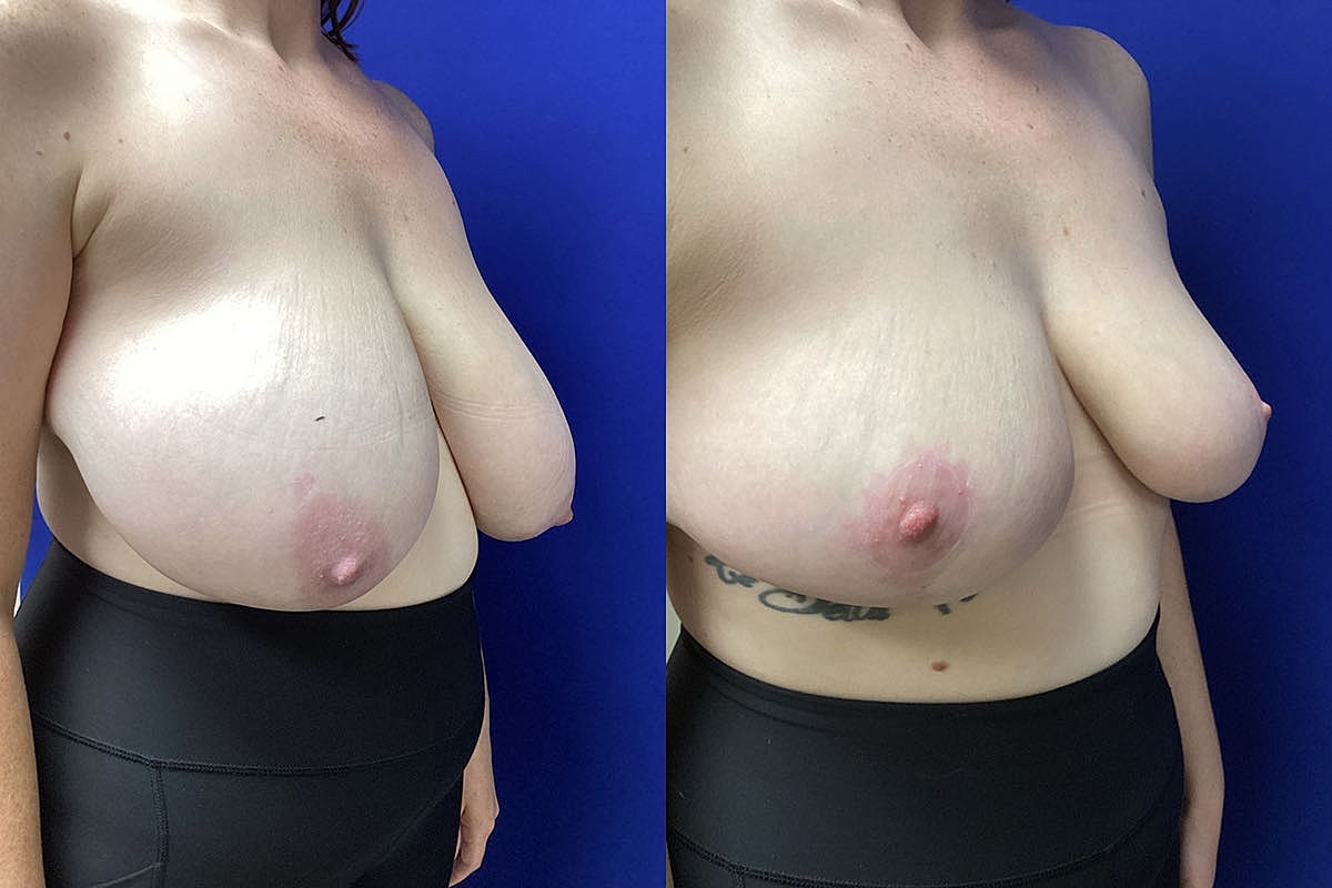 Short Scar Breast Lift and Reduction | Plastic Surgery Group of Memphis