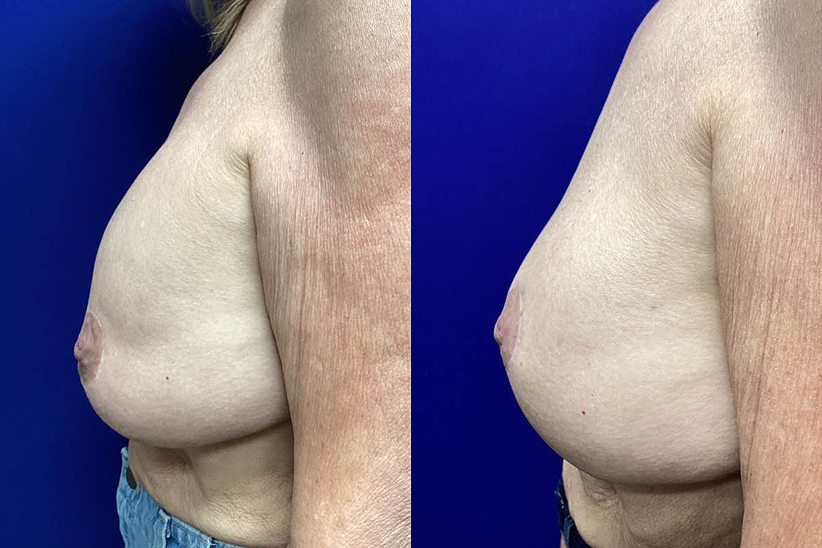 Implant Downsize | Plastic Surgery Group of Memphis