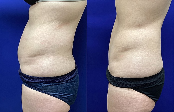 Ellis Tavin Liposuction