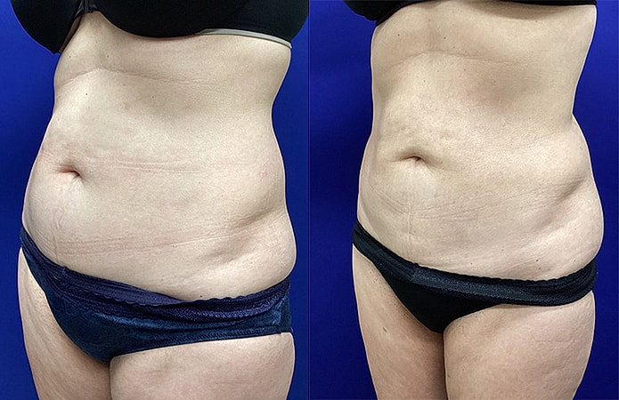 Ellis Tavin Liposuction