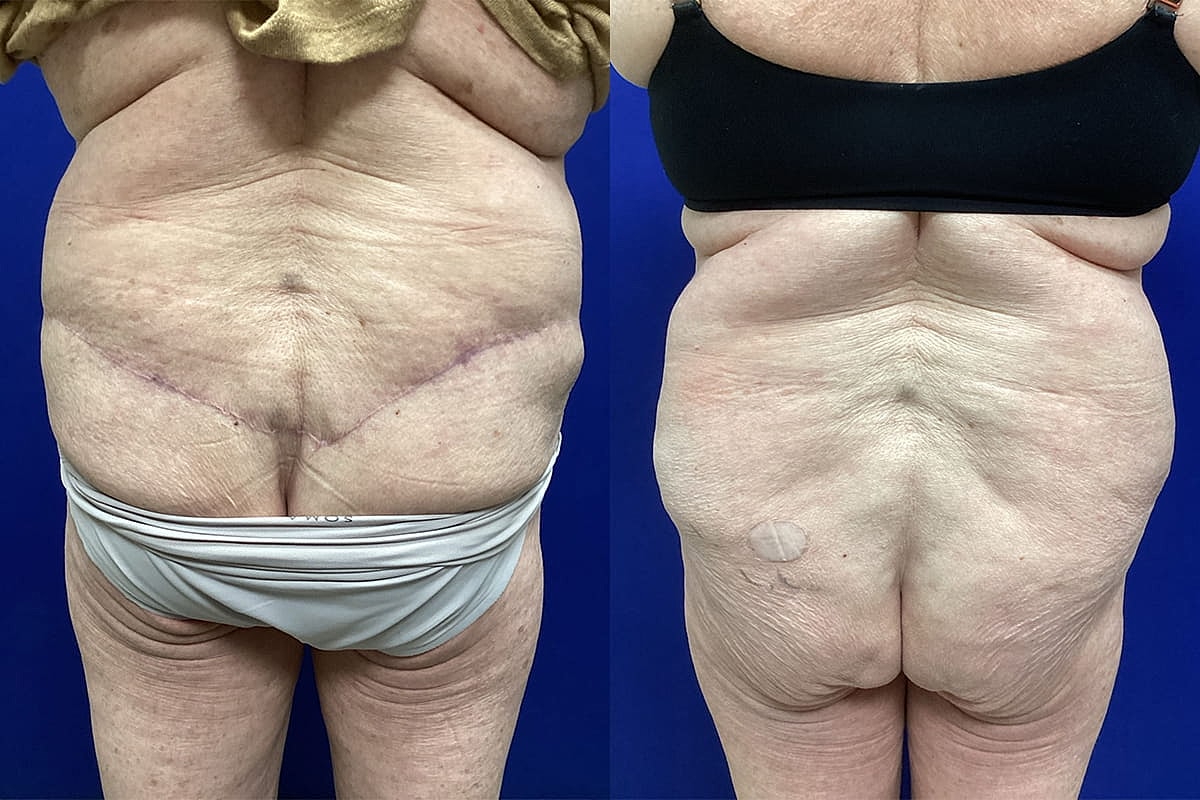 Ellis Tavin Liposuction