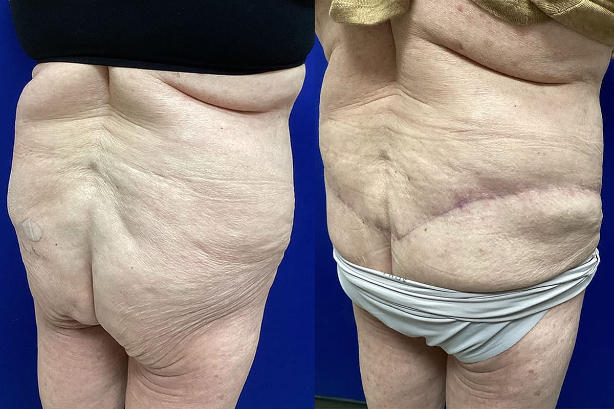 Ellis Tavin Liposuction