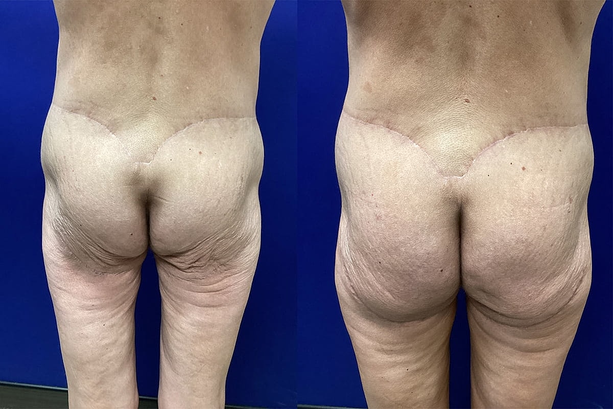 Ellis Tavin Liposuction