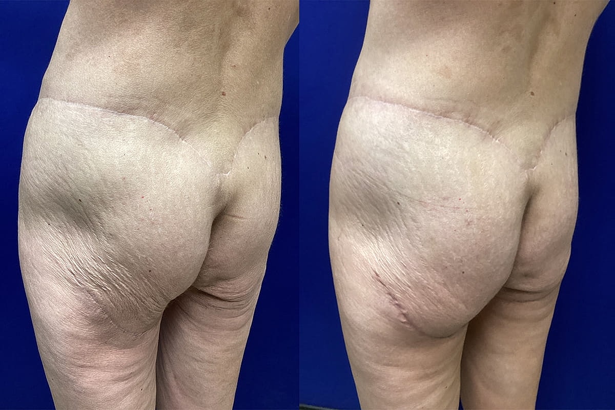 Ellis Tavin Liposuction