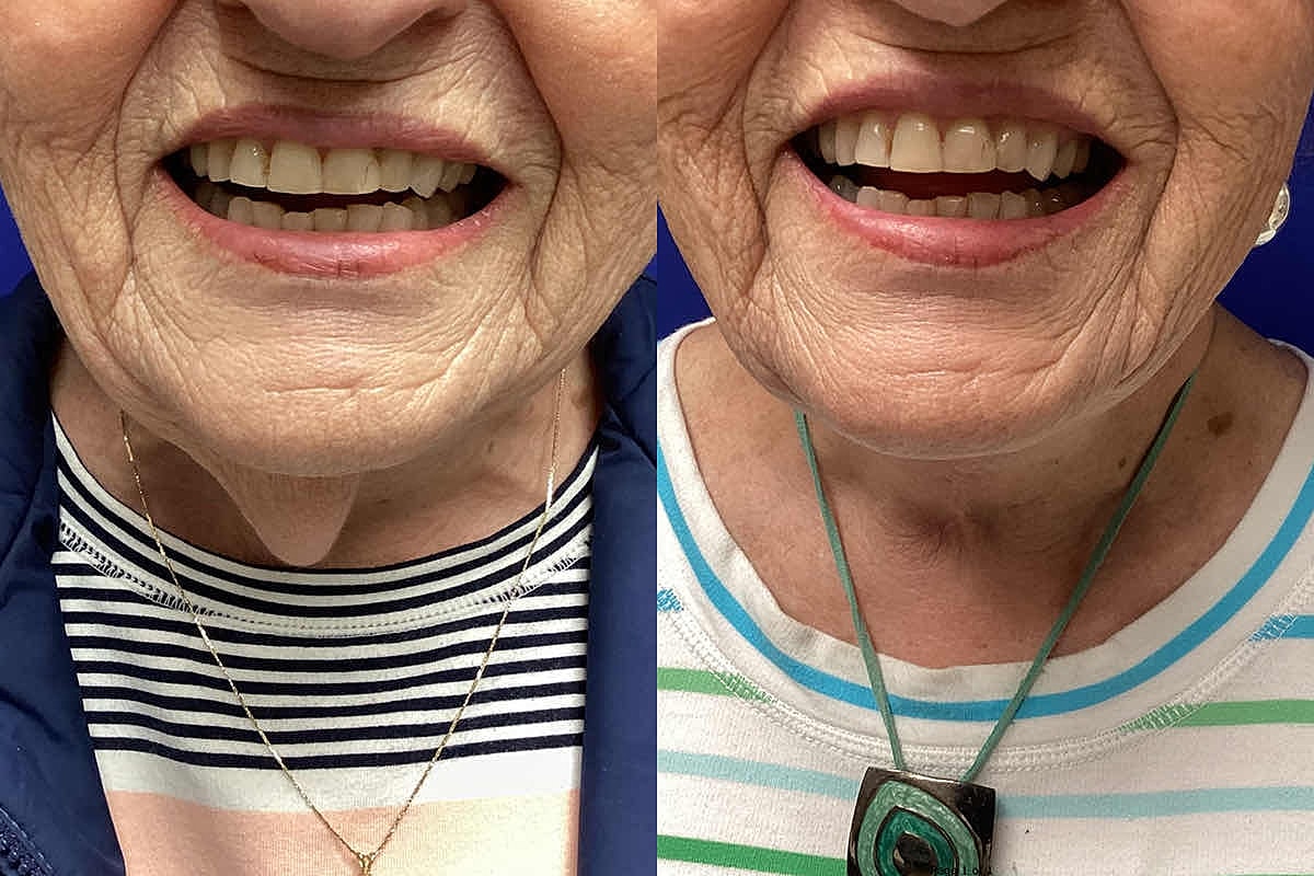 Dr. Tavin Neck Lift
