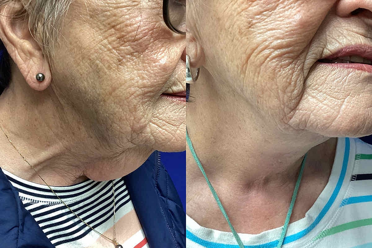 Dr. Tavin Neck Lift