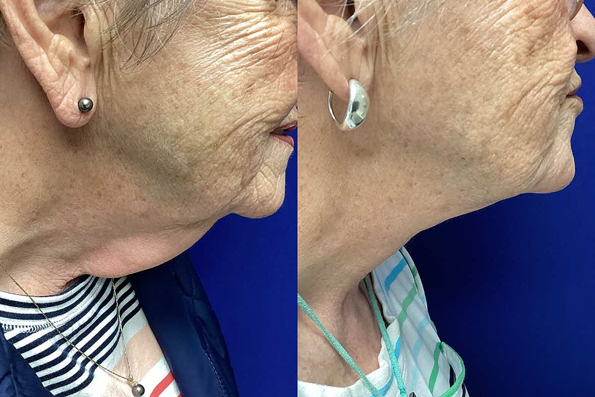 Dr. Tavin Neck Lift
