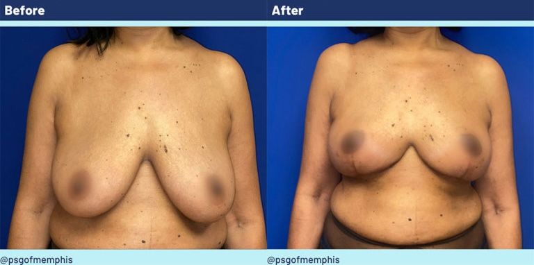 Breast Lift Before & After
