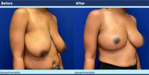 Breast Lift Before & After