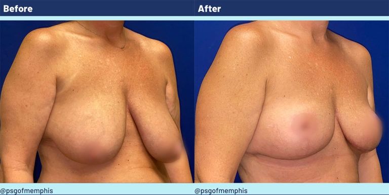 Breast Lift Before & After