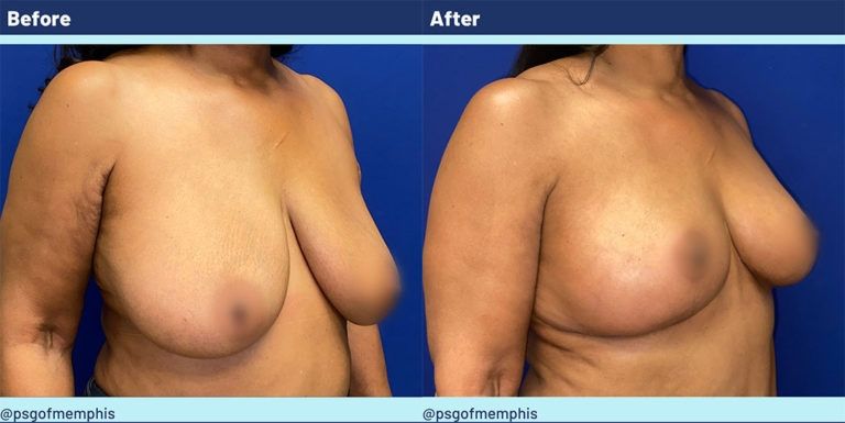 Breast Lift Before & After