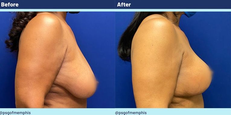 Breast Lift Before & After