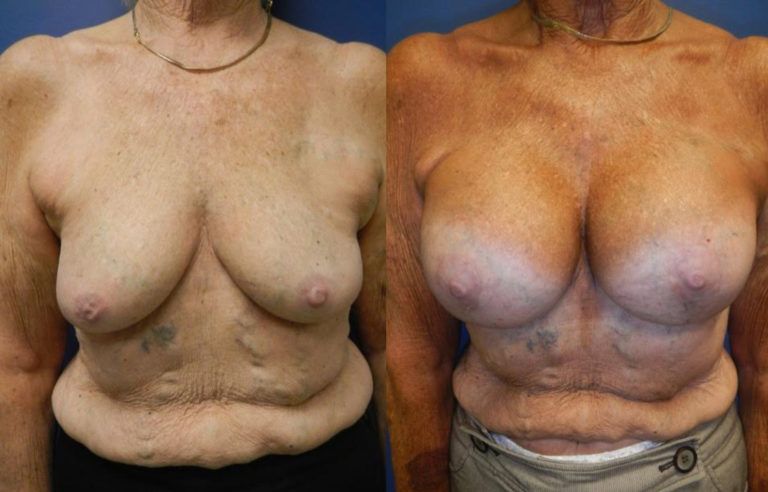 Breast Lift Before & After