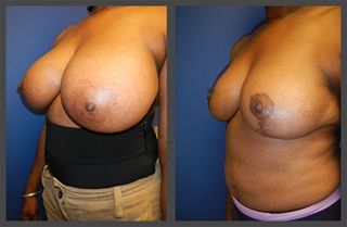 Breast Lift Before & After