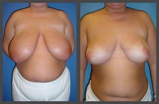 Breast Lift Before & After