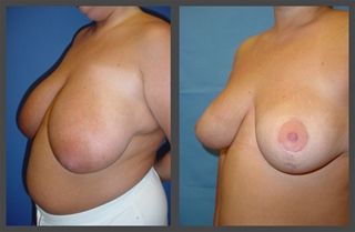 Breast Lift Before & After