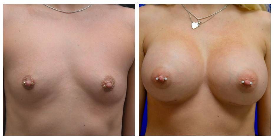 Breast Augmentation Before & After
