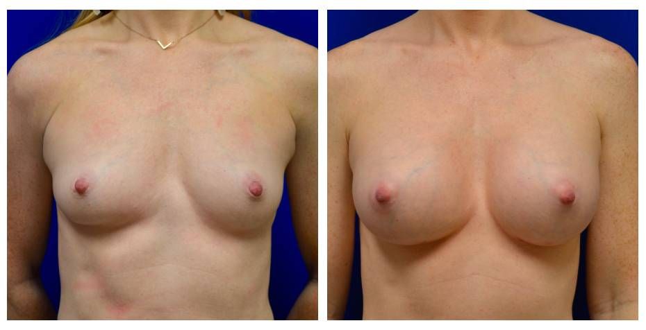 Breast Augmentation Before & After
