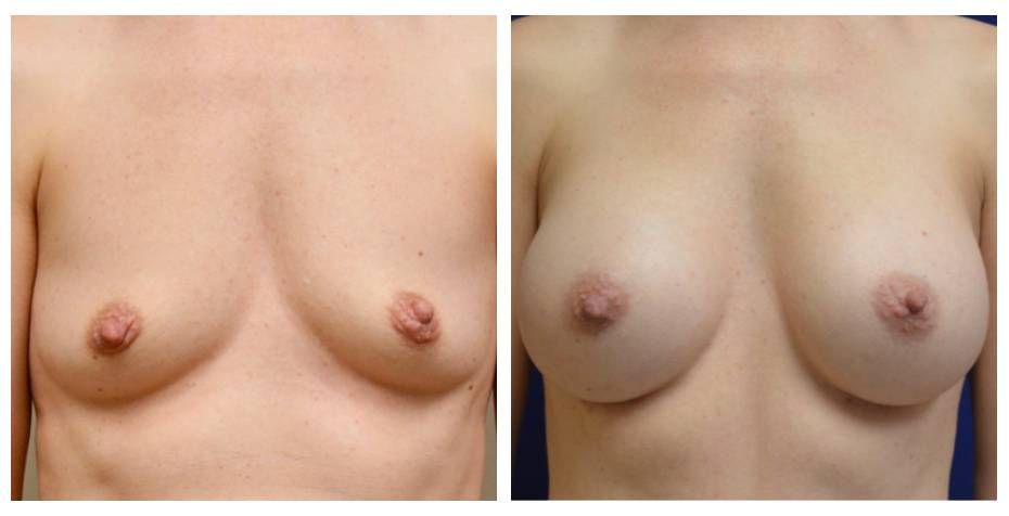 Breast Augmentation Before & After