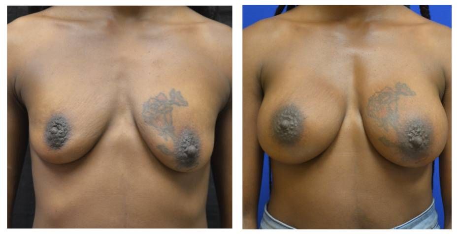 Breast Augmentation Before & After