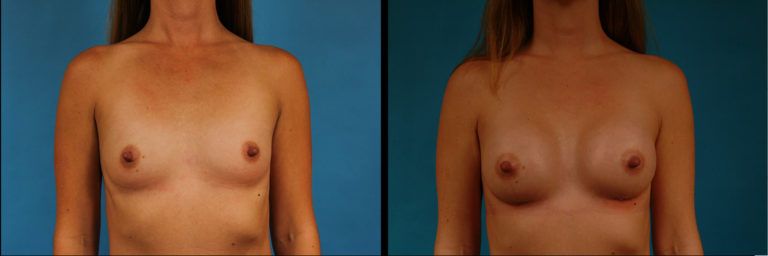 Breast Augmentation Before & After