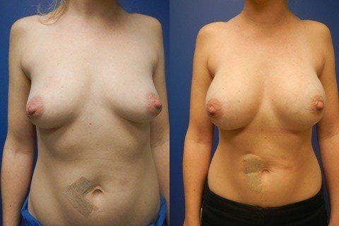Breast Augmentation Before & After