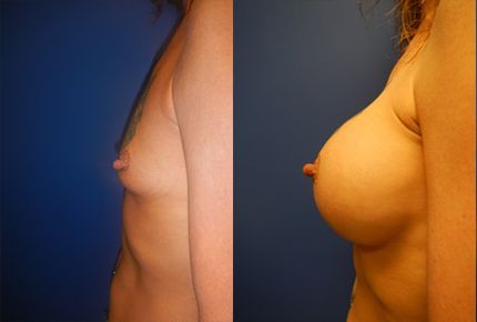 Breast Augmentation Before & After