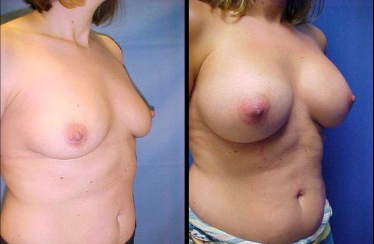 Breast Augmentation Before & After