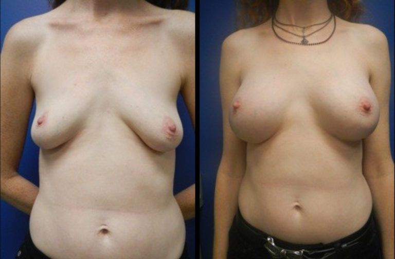 Breast Augmentation Before & After