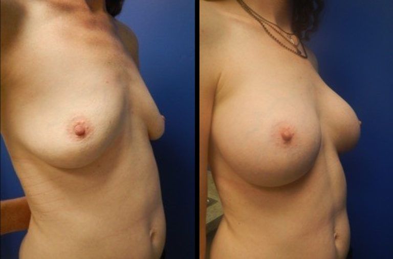 Breast Augmentation Before & After