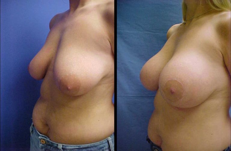 Breast Augmentation Before & After