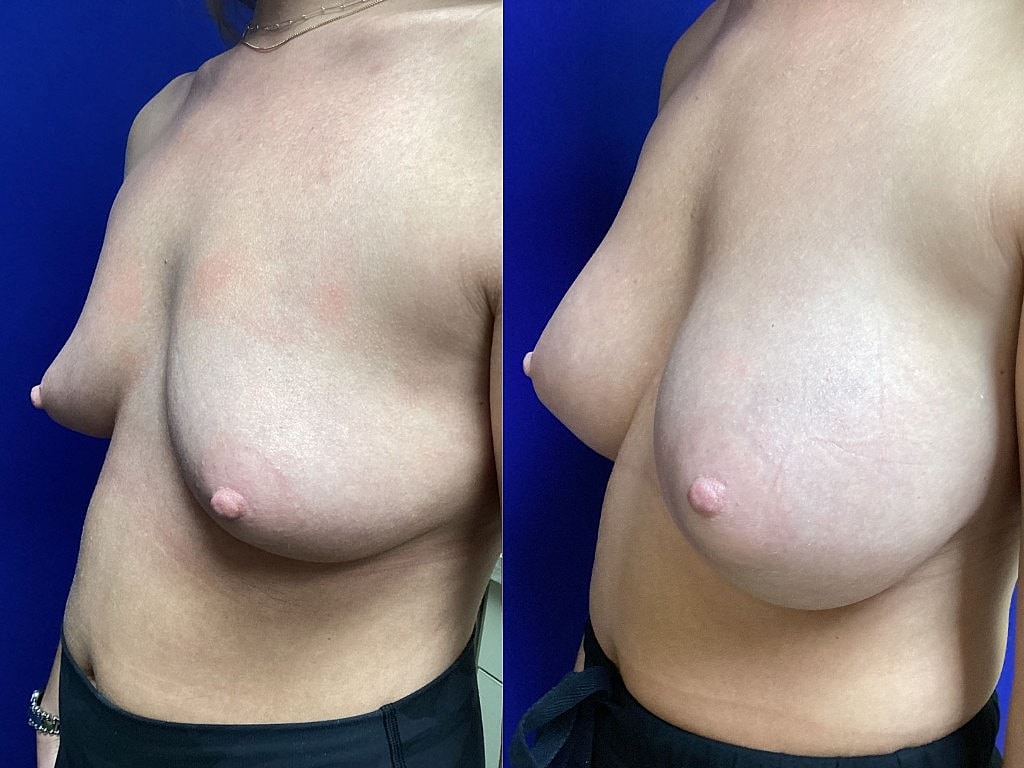 Breast Augmentation Before & After