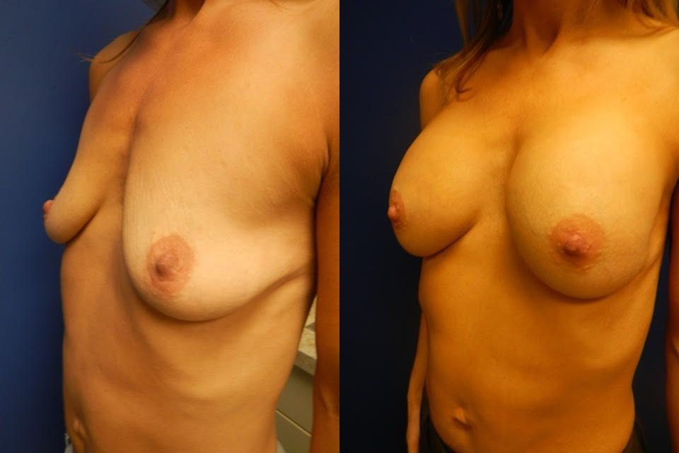 Breast Augmentation Before & After