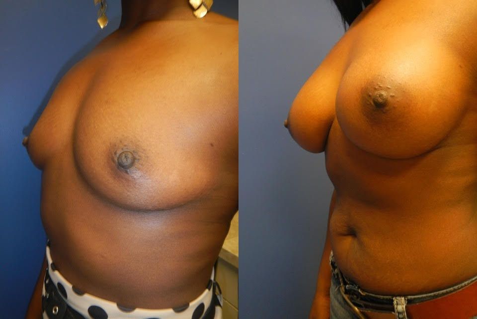 Breast Augmentation Before & After