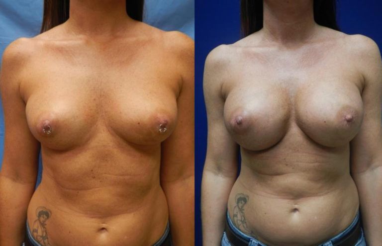 Breast Augmentation Before & After