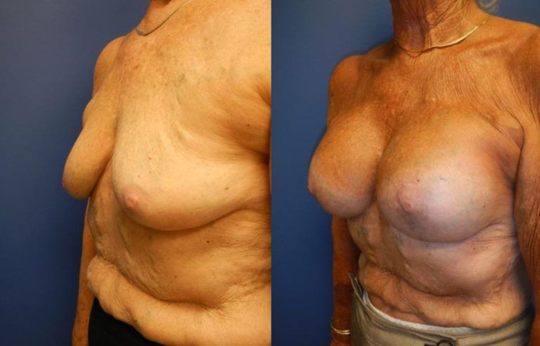 Breast Augmentation Before & After