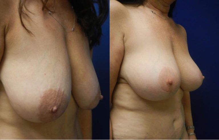 Mommy Makeover Before & After